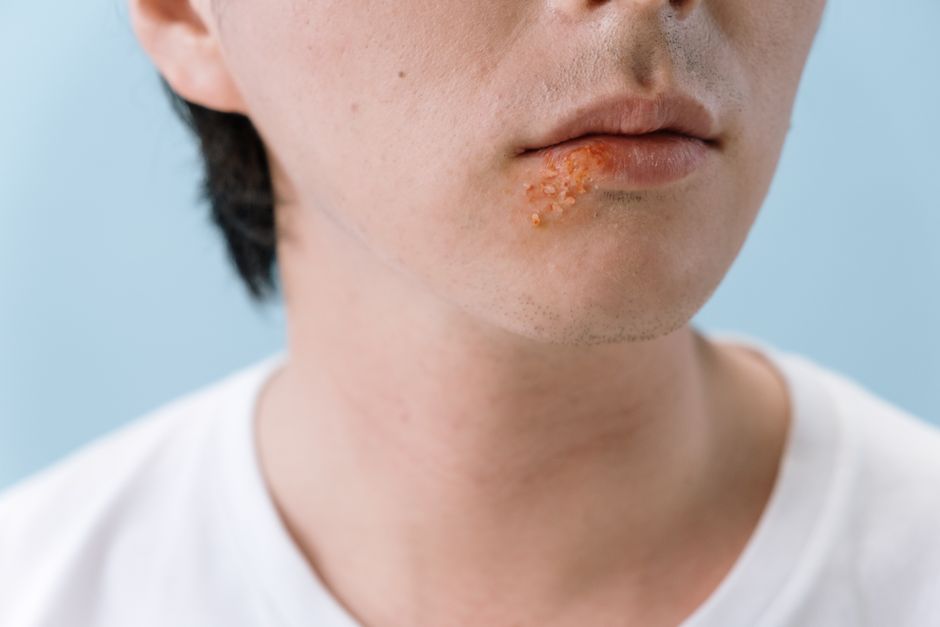 Herpes virusi: Tihi neprijatelji koji se bude tokom života