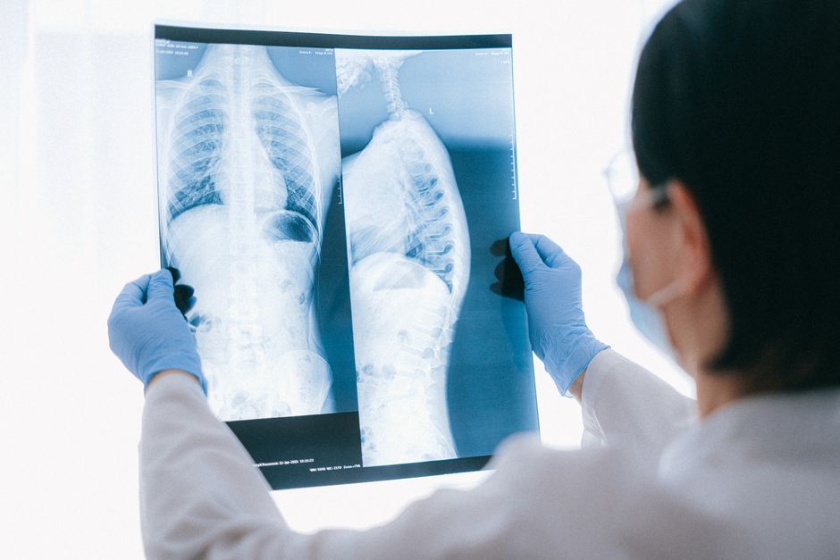 Prevencija raka pluća kod nepušača: Šta otkrivaju najnoviji medicinski podaci?